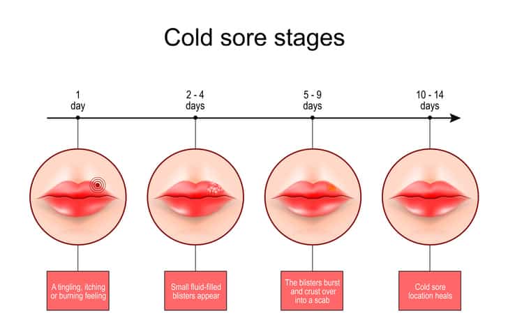 What Is A Cold Sore Stasny Dental
