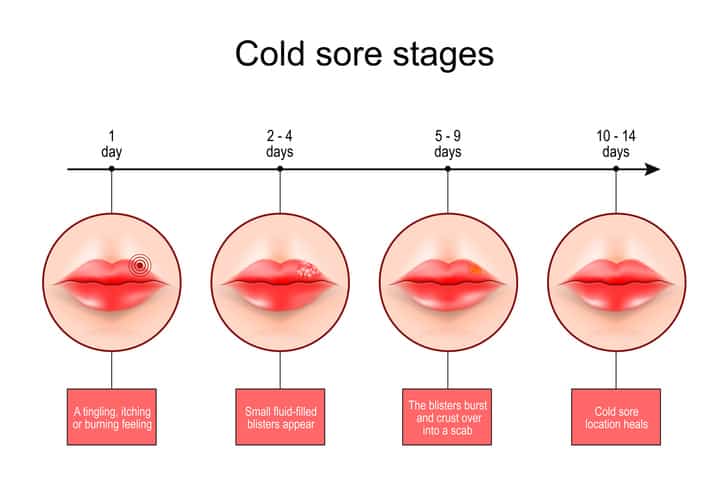 what-are-cold-sores-how-to-get-rid-of-them-youtube